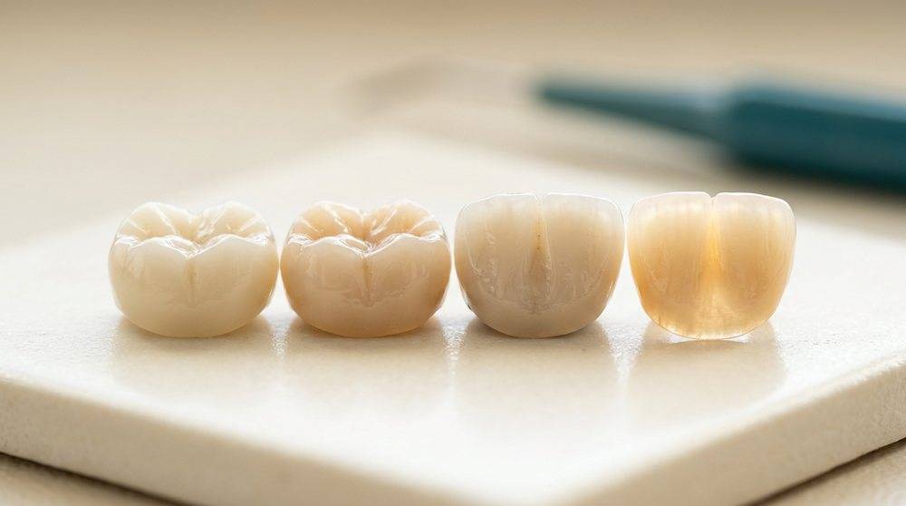 A row of dental crowns showing the range from opaque, high-strength zirconia to translucent, lifelike lithium disilicate