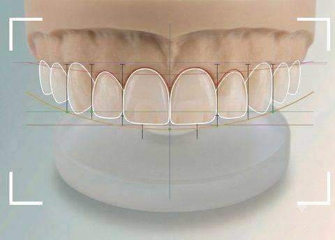 Smile Design
